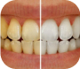 Teeth Wightening