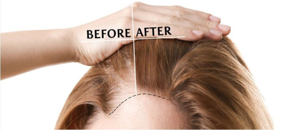 Advantages of DHI Hair Transplant for Women